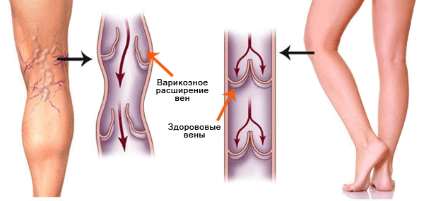 Варикоз