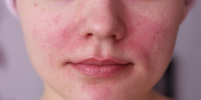  Аллергия на крем для лица
