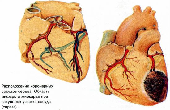 Инфаркт миокарда
