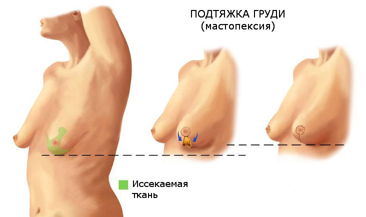  Как подтянуть обвисшую грудь - отзывы и цены в Москве