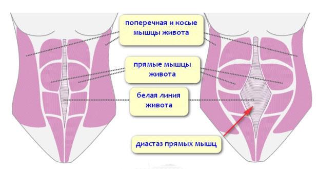 что такое диастаз прямых мышц живота