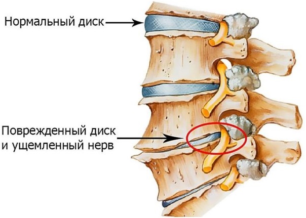 Возрастные изменения в позвоночнике