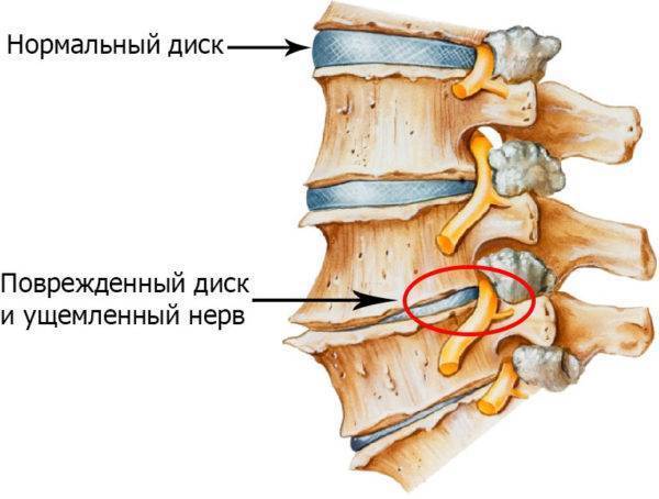 Лфк при остеохондрозе пояснично-крестцового отдела позвоночника, комплекс упражнений лечебной гимнастики