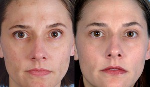 Ультразвуковая чистка лица: до и после