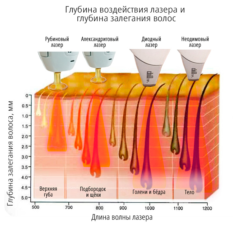 Глубина воздействия лазера для эпиляции