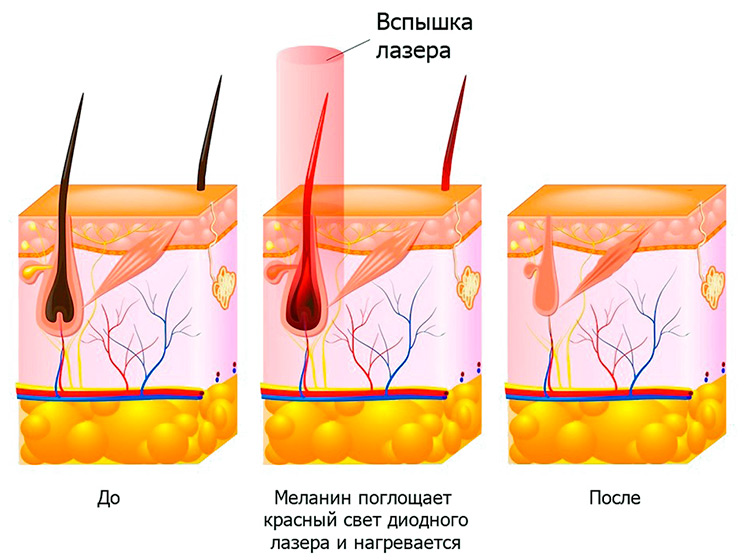 Принцип лазерной эпиляции