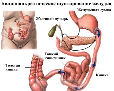Билиопанкреатическое шунтирование желудка