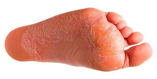 Причины и лечение шелушения кожи на ногах