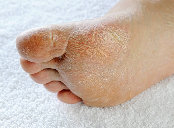 Причины и лечение шелушения кожи на ногах