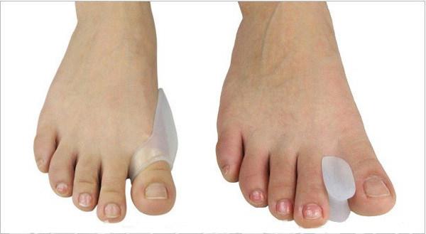 лечение шишек на ногах у большого пальца 
