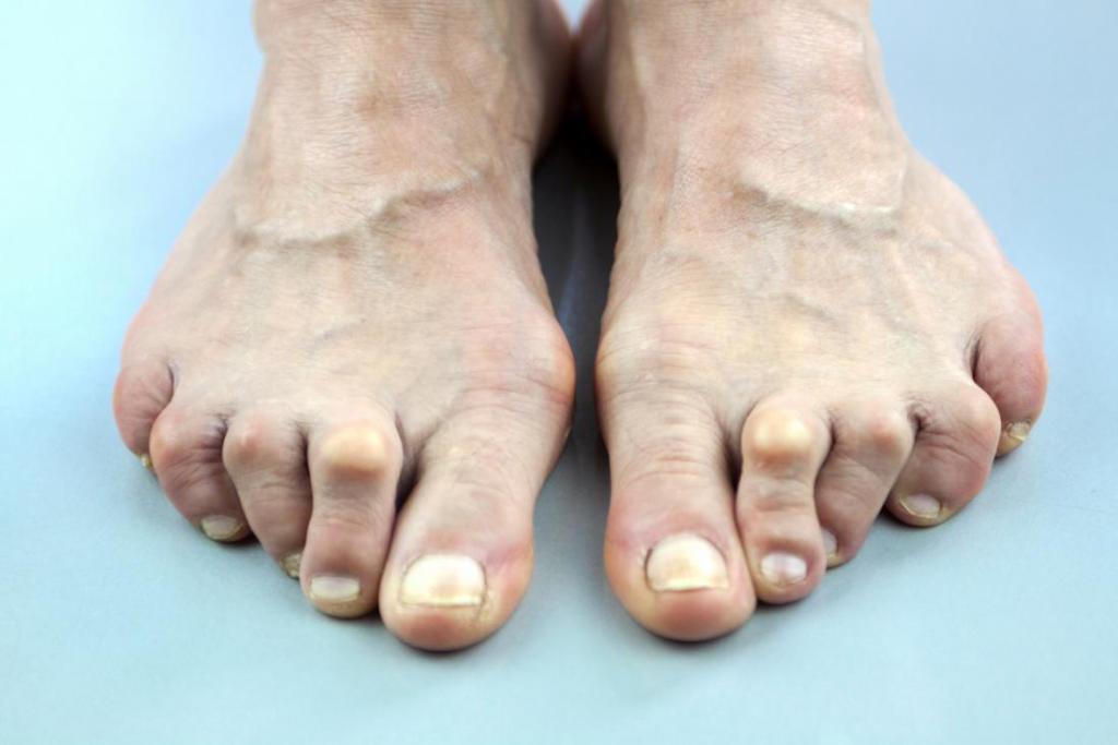 шишки на пальцах ног
