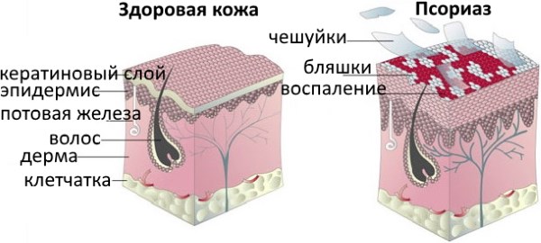 Сухое пятно на коже шелушится и чешется. Что это, что делать, как лечить