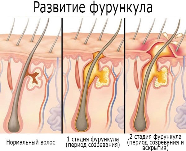 Мелкие пупырышки, сыпь на руках, ногах, голове, спине. Что это такое, как лечить