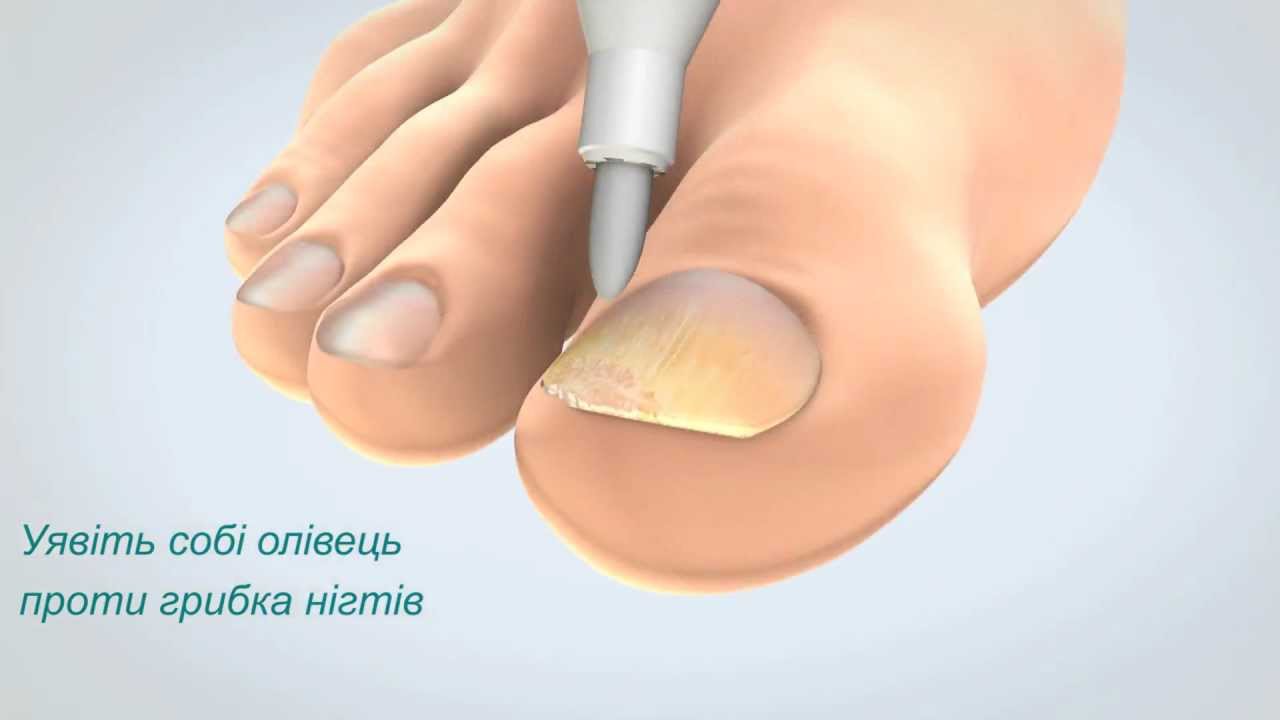Врач лечение ногтей на ногах