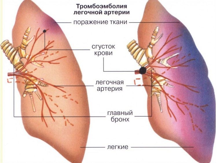 Тромбоэмболия легочной артерии