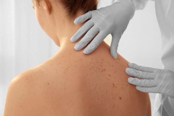 Факторы, способствующие возникновению прыщей на плечах и коже спины
