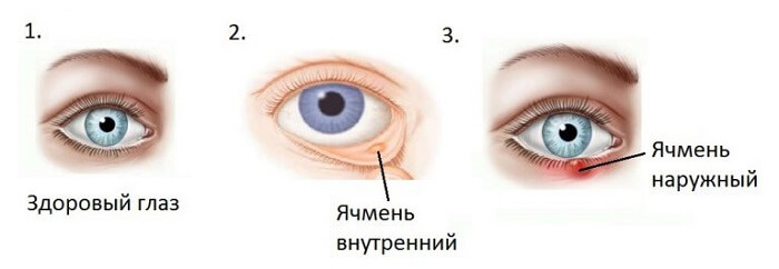 Здоровый глаз и ячмень