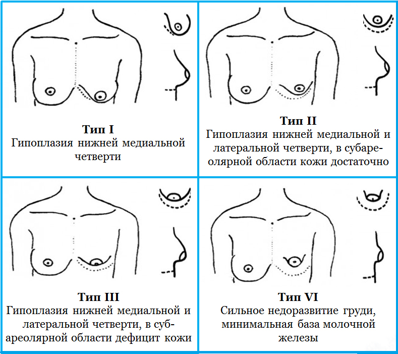 Асимметрия молочных желез