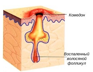 Основные причины возникновения комедонов