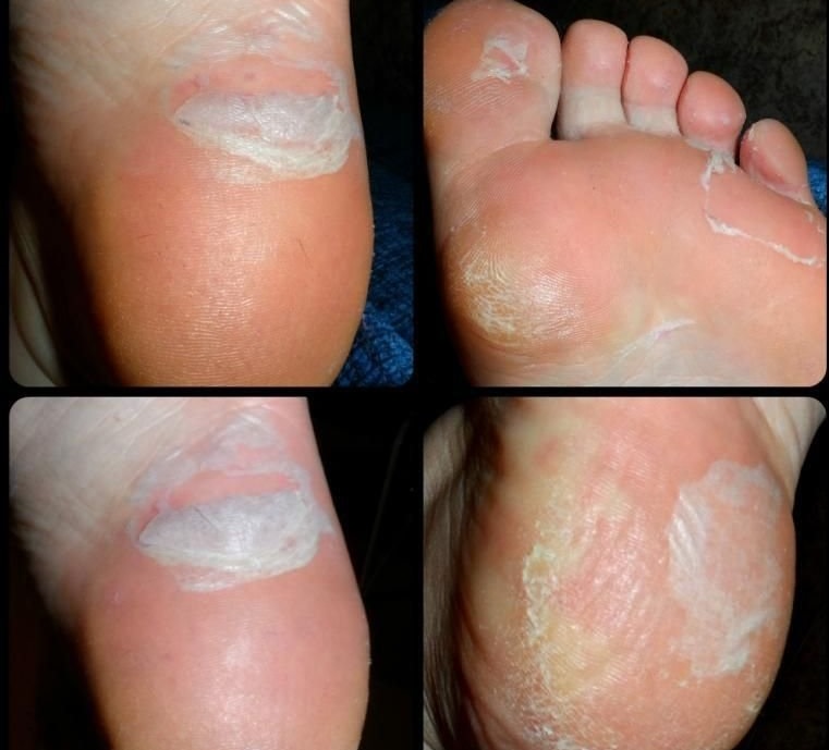 Облазит кожа на ступнях ног и пальцах: причины и лечение