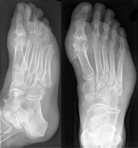 Рентгеновский снимок стопы с артрозом пальца