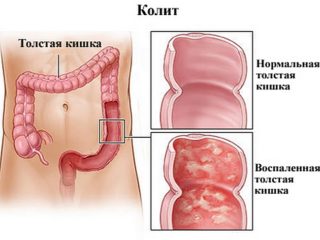 Проблема боли в животе