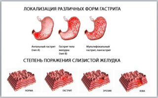 Проблема боли в животе