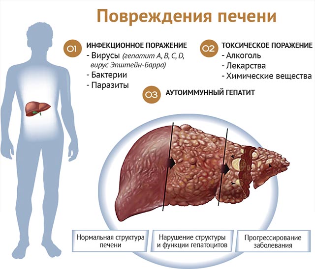 Заболевание печени