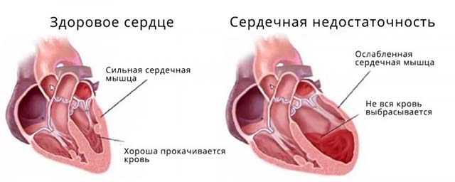 Изображение здорового и больного сердца