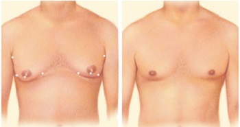 Липосакция грудных желез у мужчин