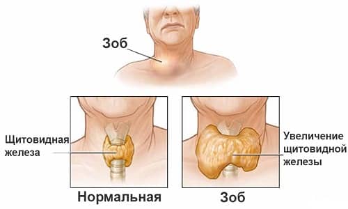 Йод участвует в выработке гормонов щитовидной железы, и его нехватка приводит к развитию эндемического зоба