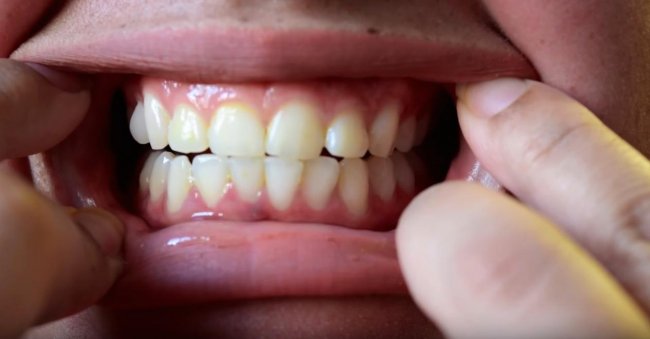 Безопасное отбеливание зубов в домашних условиях