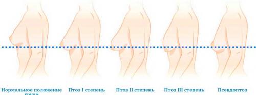 Упражнения, чтобы подтянуть обвисшую грудь. Отвисшая грудь (мастоптоз): стадии, как бороться, как избежать обвисания груди