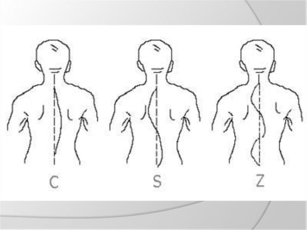 Типы сколиоза