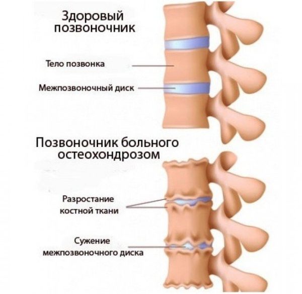 Здоровый позвоночник и позвоночник больного остеохондрозом