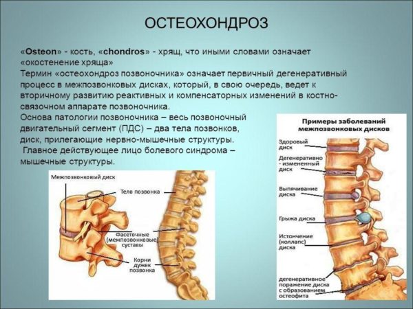 Определение остеохондроза