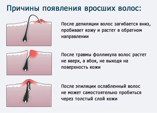 Как избавиться от вросших волос после депиляции