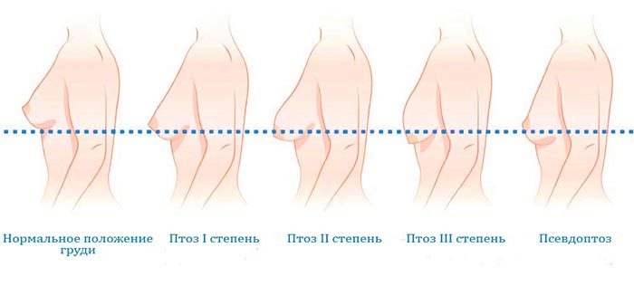 Степени обвисания груди