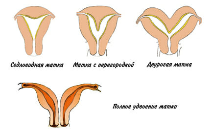 Аномалии строения матки