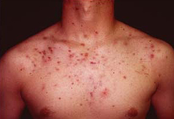 Узловатокистозные угри (acne nodulocystica)
