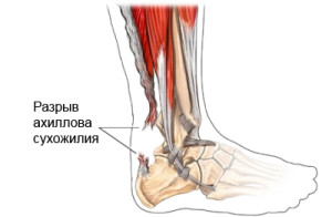 Разрыв сухожилия
