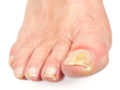 грибок на ногтях ног лечение народными средствами