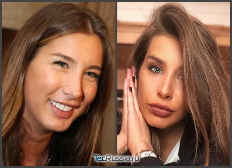 Кэти Топурия до и после контурной пластики губ