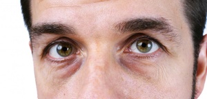 Болезни влияющие на мешки под глазами