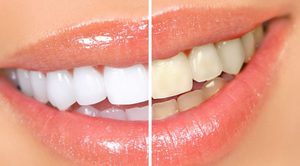 Какими способами отбеливают зубы