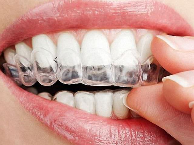 Капы применяются для отбеливания зубов